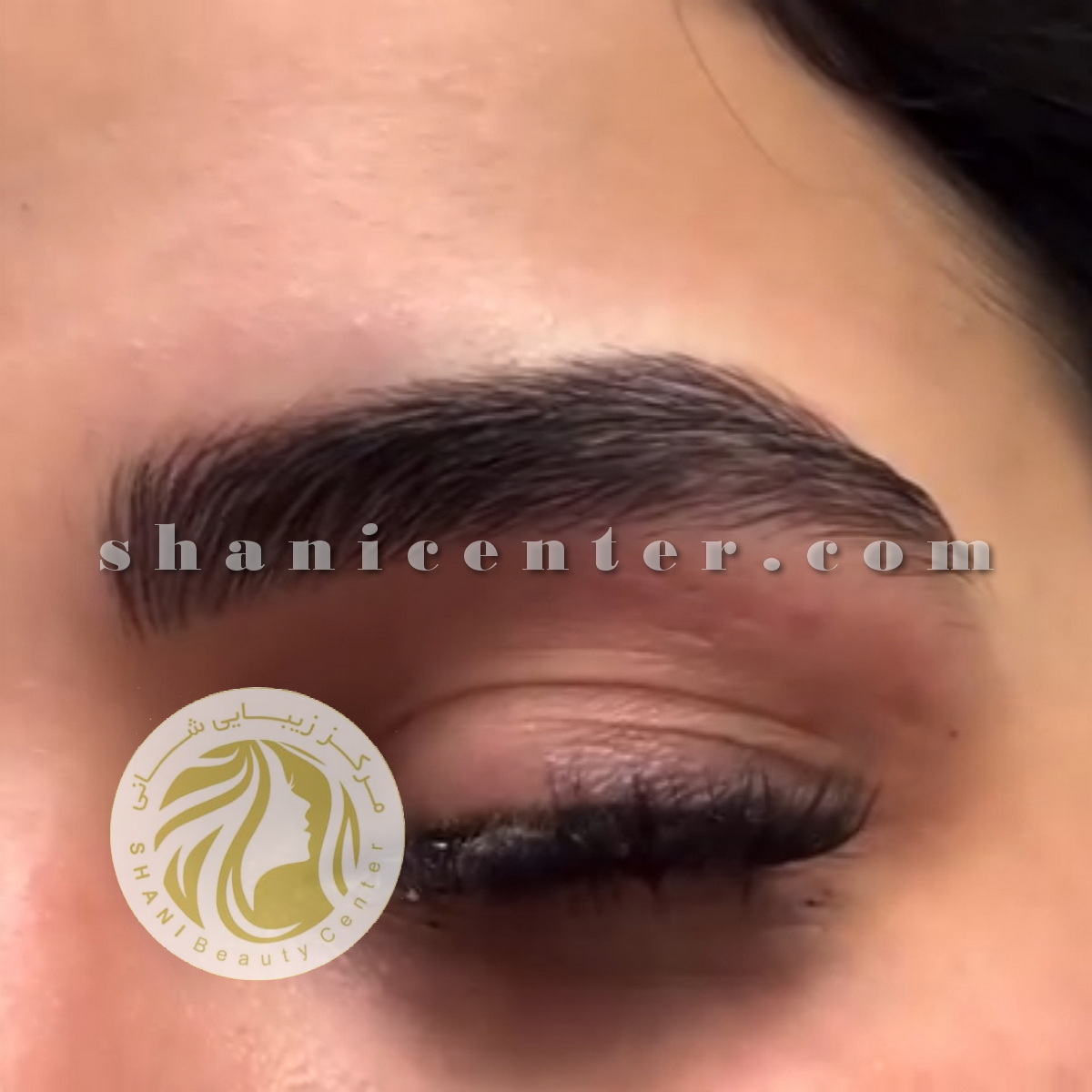 میکروبلیدینگ و میکروپیگمنتیشن چشم-فقط چشم (2)